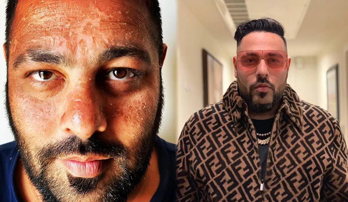 rapper badshah suffers sunburn - India TV Hindi