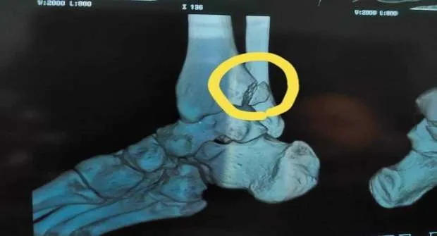 Mamata Banerjee's x-ray report shows fracture in left ankle- India TV Hindi