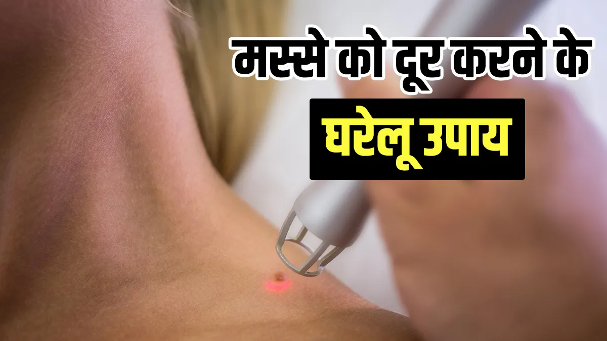 Home remedy to remove warts- India TV Hindi