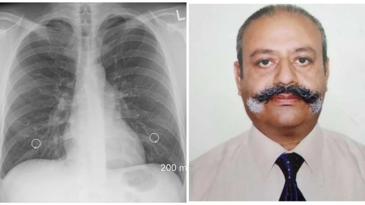Tuberculosis TB Disease-Dr. Ajay Kochhar - India TV Hindi