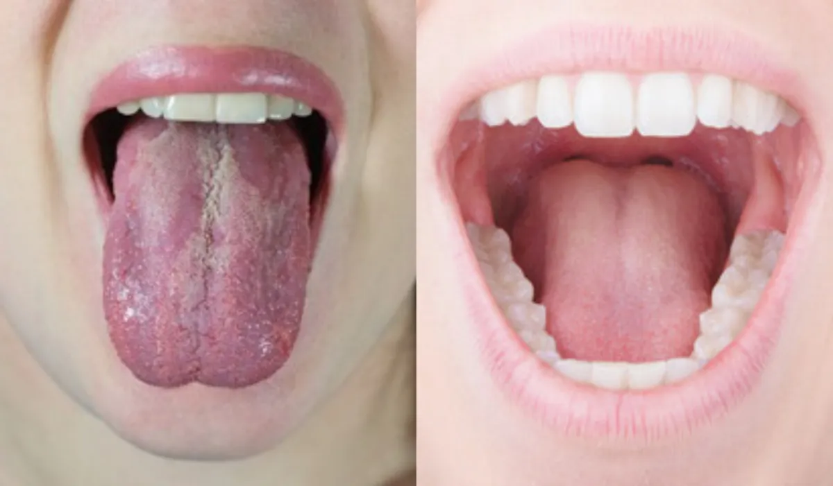 how to remove white layer from tongue,- India TV Hindi