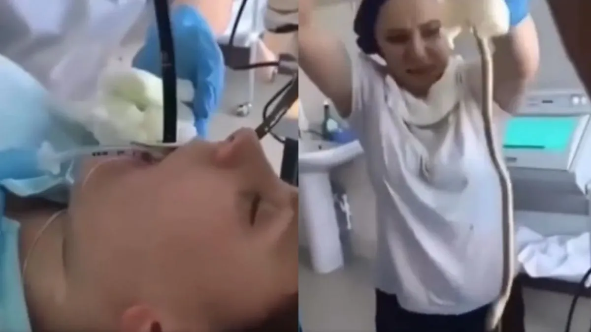 डॉक्टर ने महिला के मुंह से सांप को खींचकर बाहर निकाला।- India TV Hindi