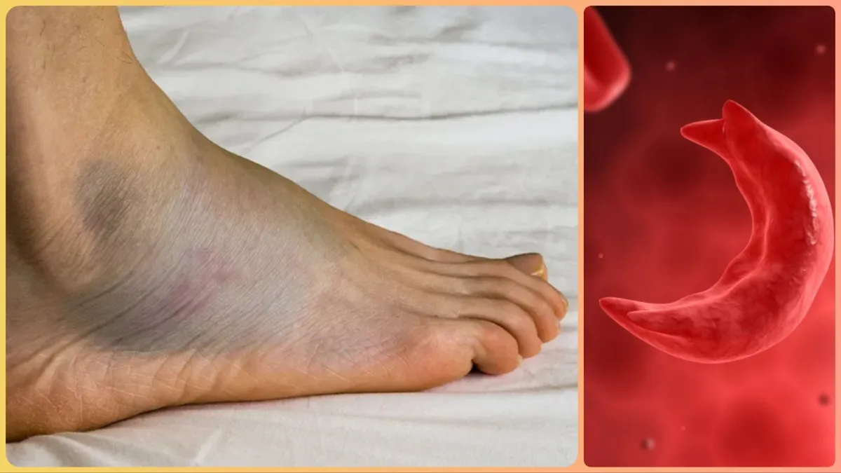  Sickle_cell_anemia_symptoms- India TV Hindi