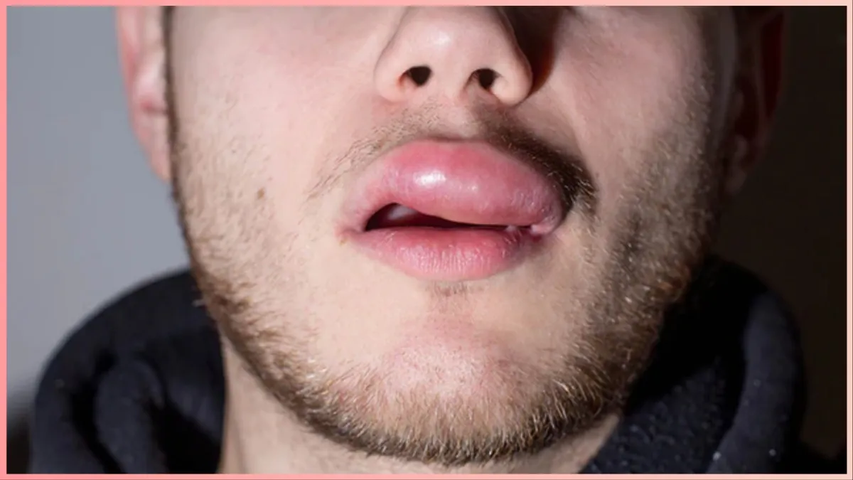 Swollen lip allergy- India TV Hindi
