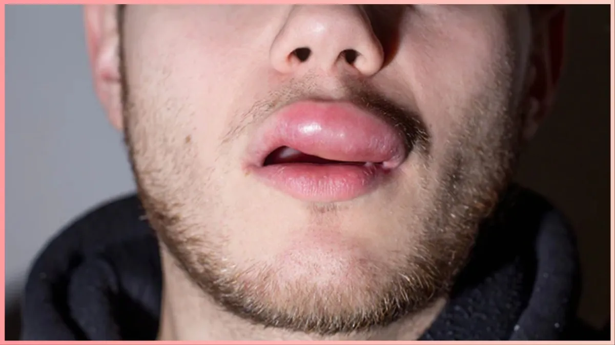 swollen-lip-reason