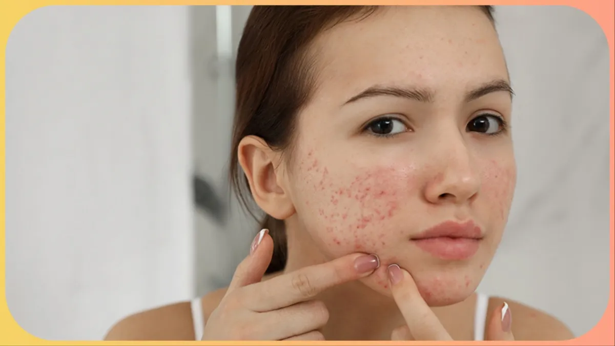 pimple free skin tips- India TV Hindi
