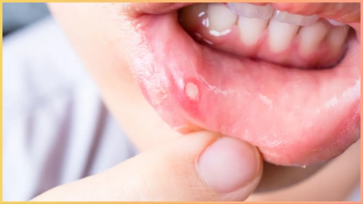 MOUTH ULCER CAUSES- India TV Hindi