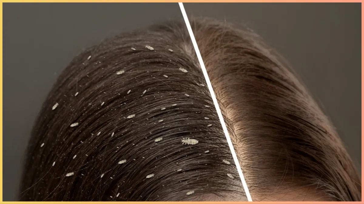 how to get rid of lice naturally- India TV Hindi