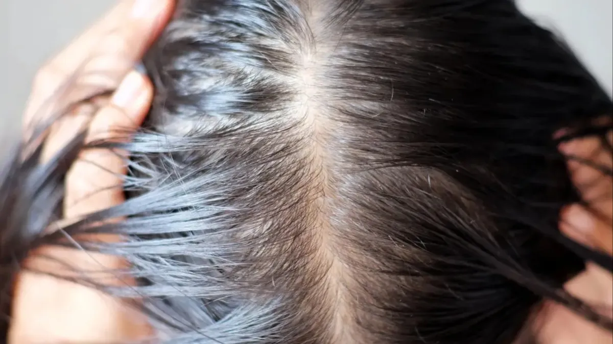 pcos hair loss treatment at home- India TV Hindi