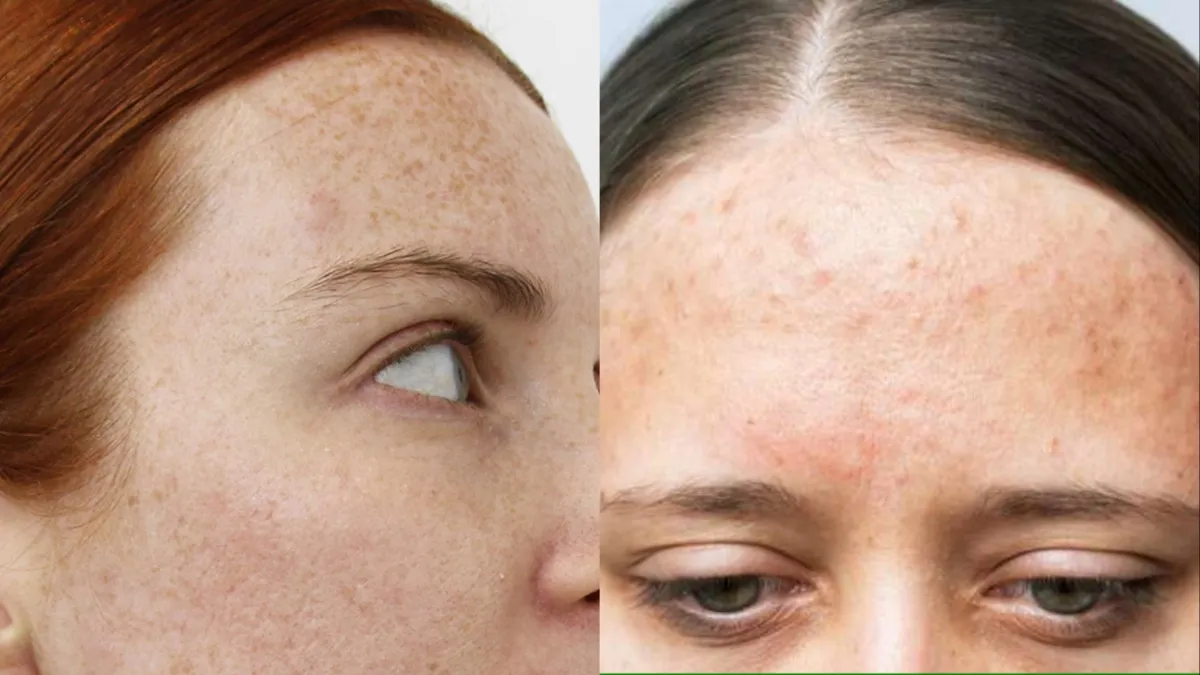  home remedies for pigmentation - India TV Hindi