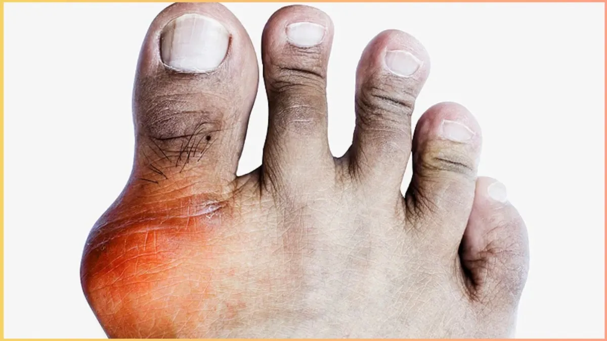 high uric acid risk effects on toes- India TV Hindi