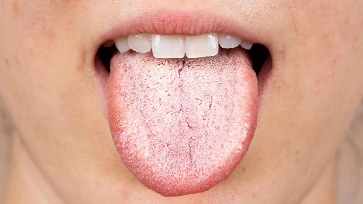 How to remove white layer from tongue - India TV Hindi