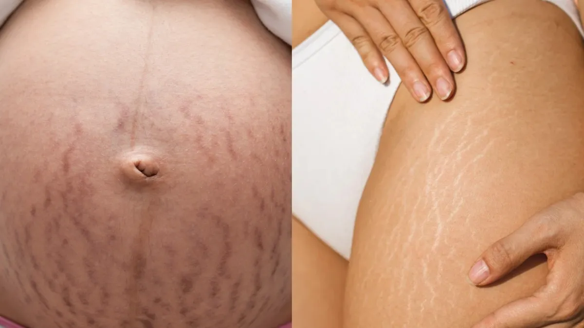  Home remedies to reduce stretch marks- India TV Hindi