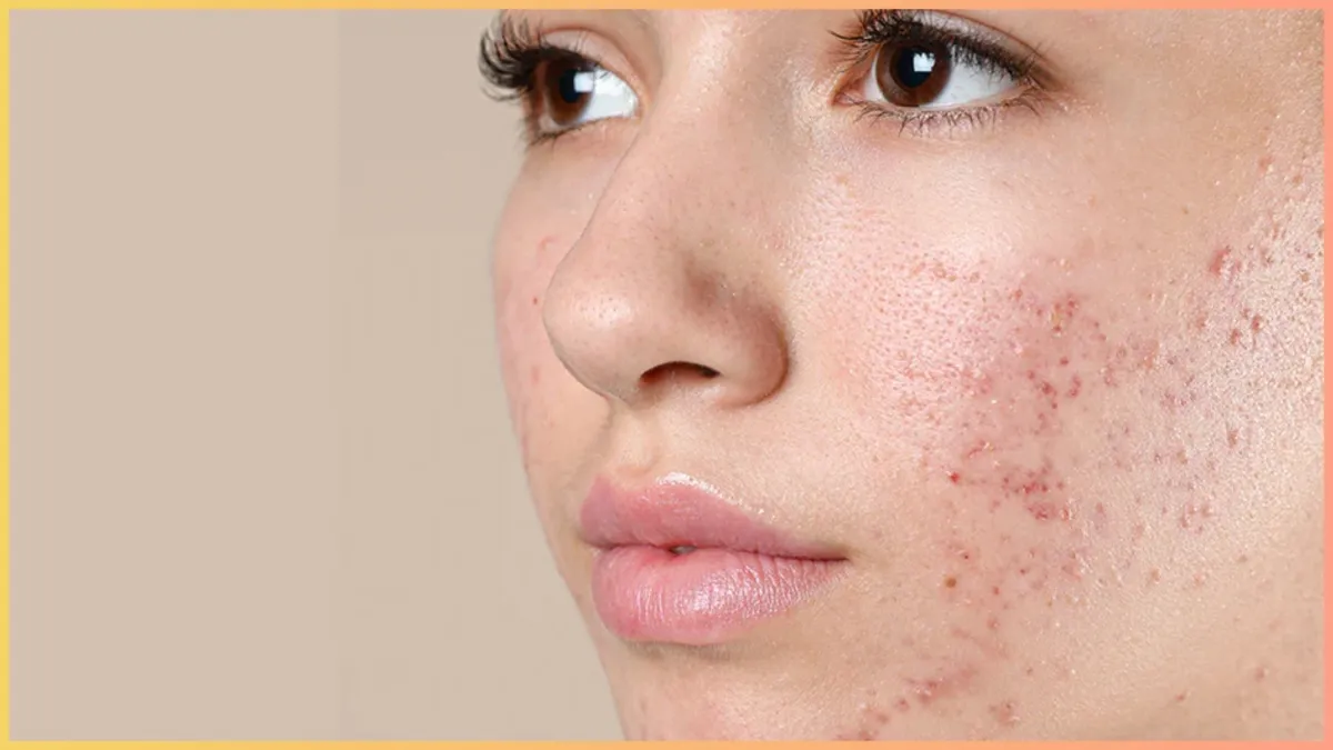  oily acne skin- India TV Hindi