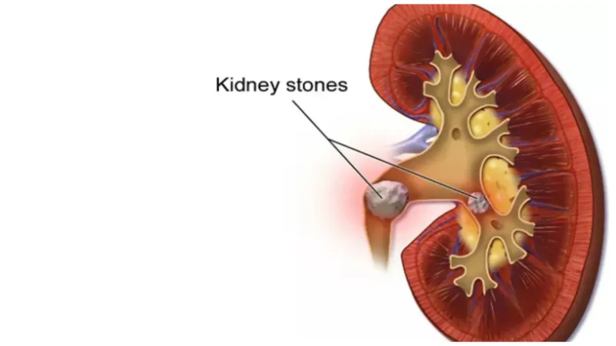 hyderabad doctors successfully conducted kidney operations found 418 stones in the kidney - India TV Hindi