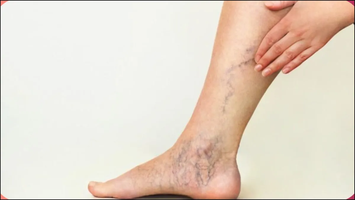 Varicose Veins Ayurvedic Treatment- India TV Hindi