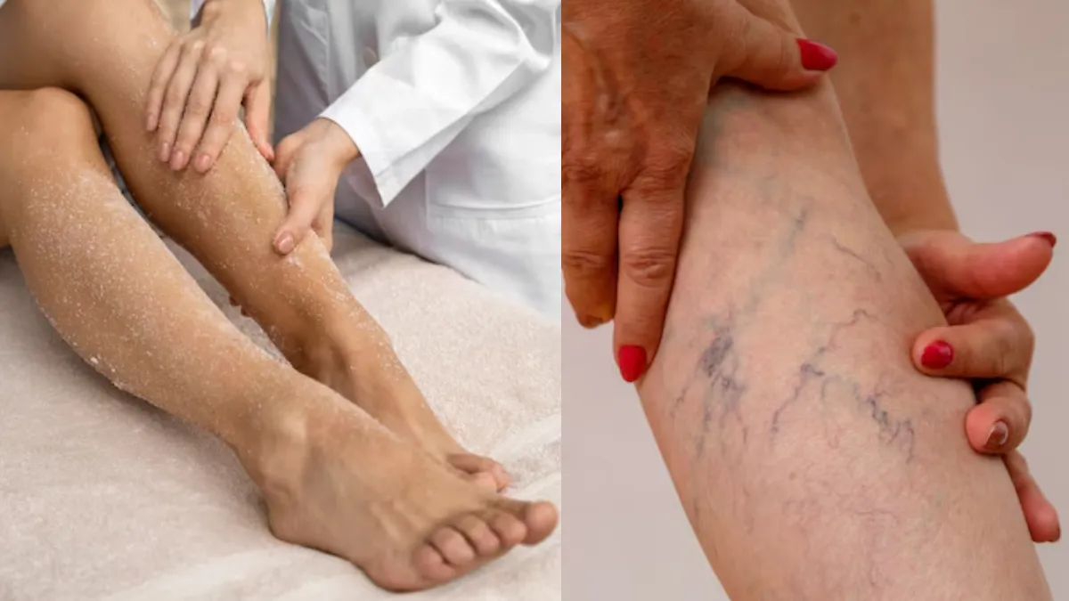 Varicose Veins - India TV Hindi