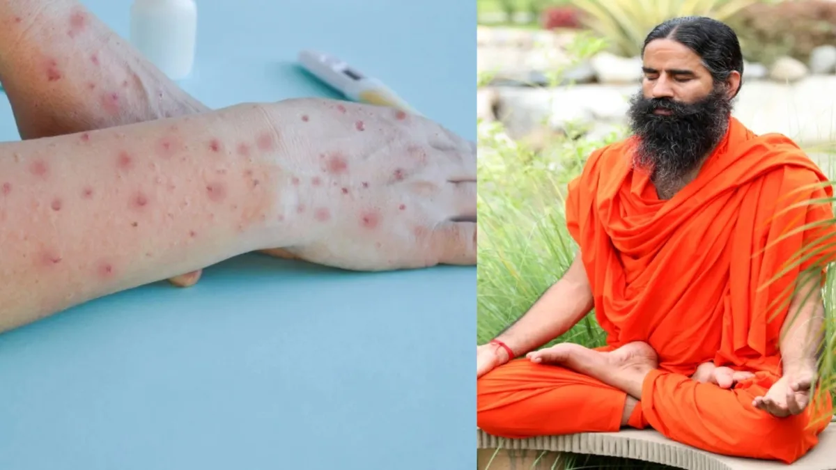 Monkeypox Home Remedy- India TV Hindi