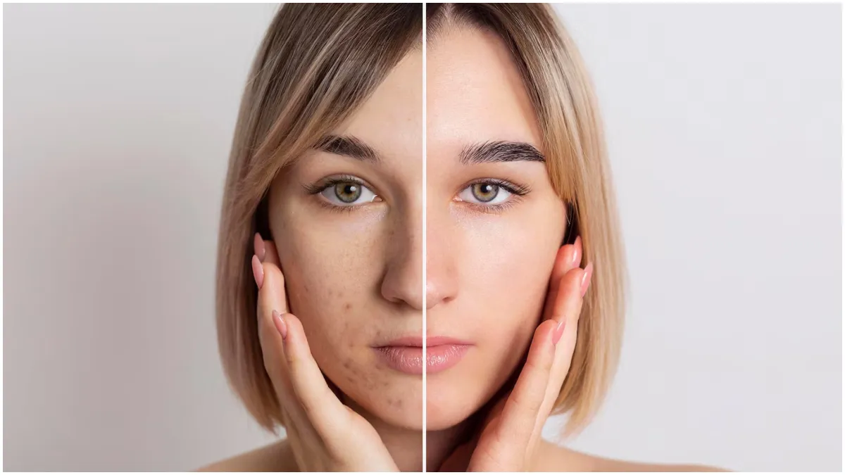 How to get rid of pigmentation?- India TV Hindi