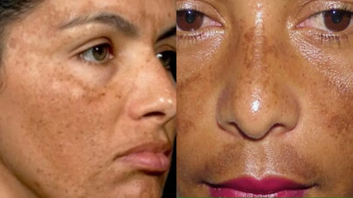 Melasma Causes And Treatment- India TV Hindi