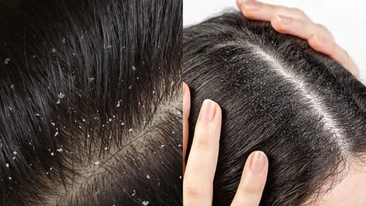 get rid of dandruff- India TV Hindi