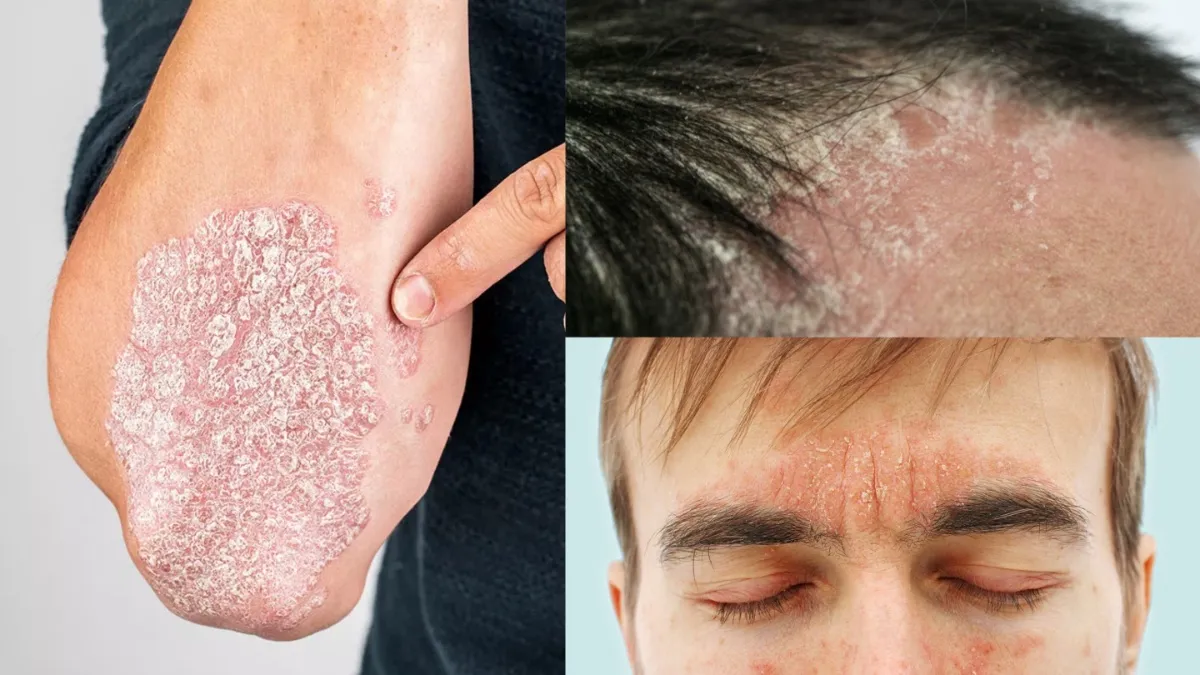 किन वजहों से होता है स्किन पर सोरायसिस