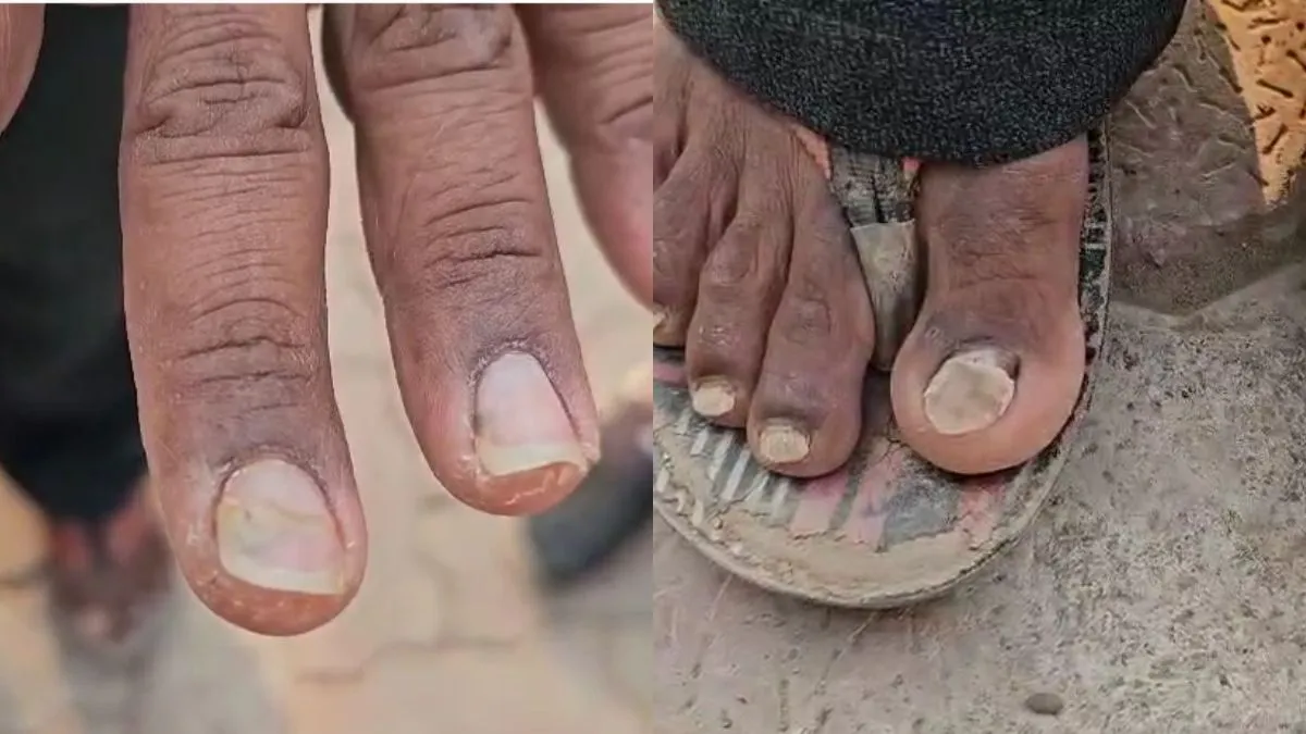 बाल झड़ने वाले मरीजों के सड़ने लगे हाथ-पैरो के नाखून- India TV Hindi