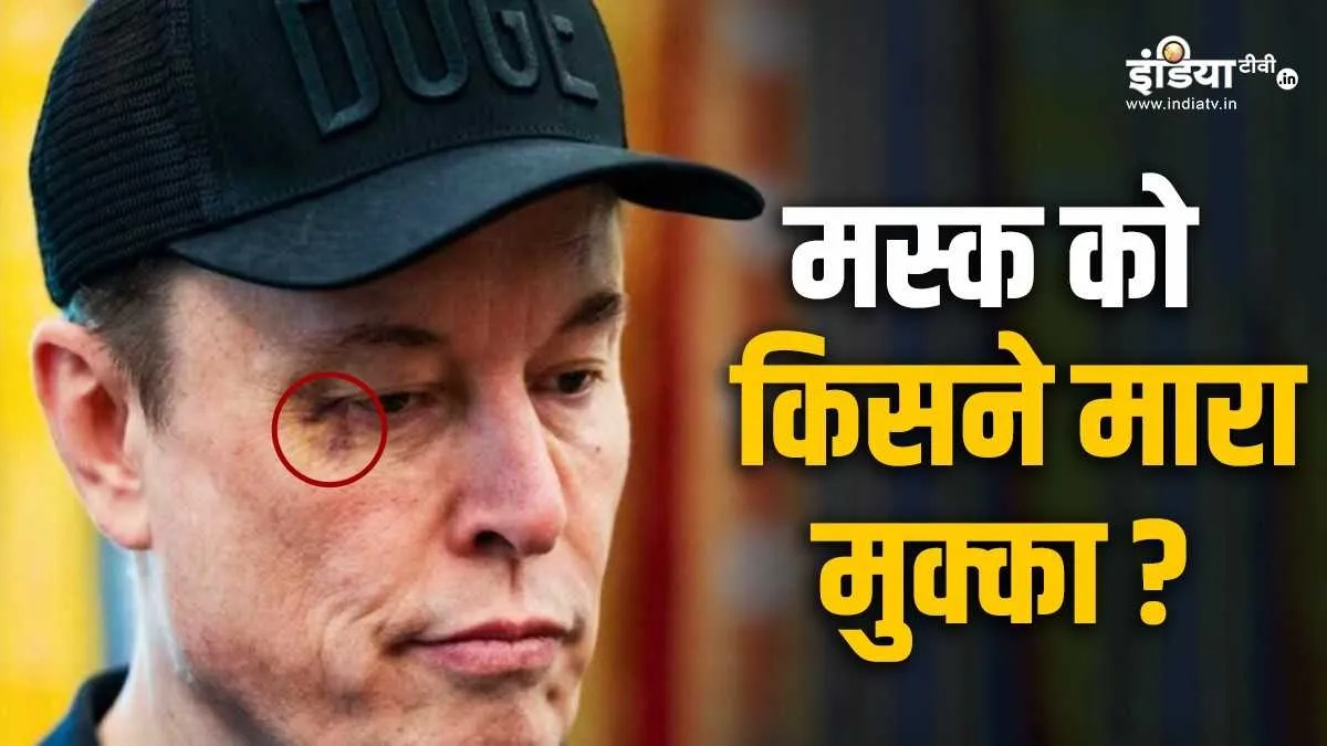 एलन मस्क की आंख में चोट के निशान