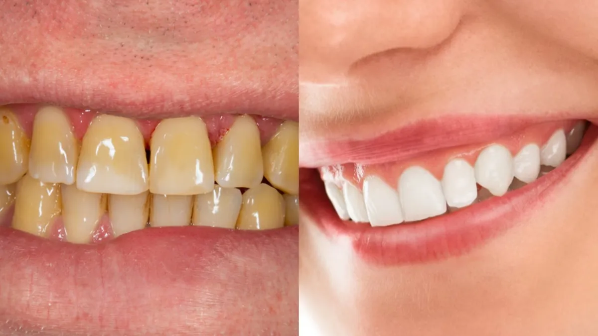 Salt and mustard oil will shine yellow teeth