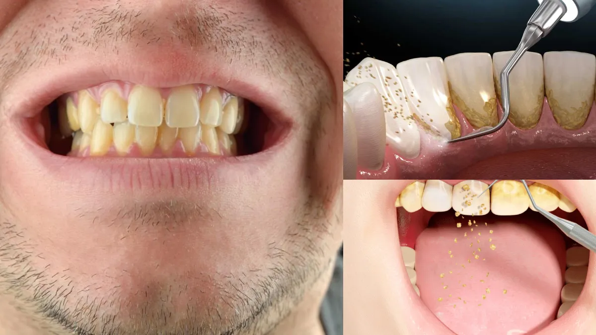 How to remove yellowing of teeth