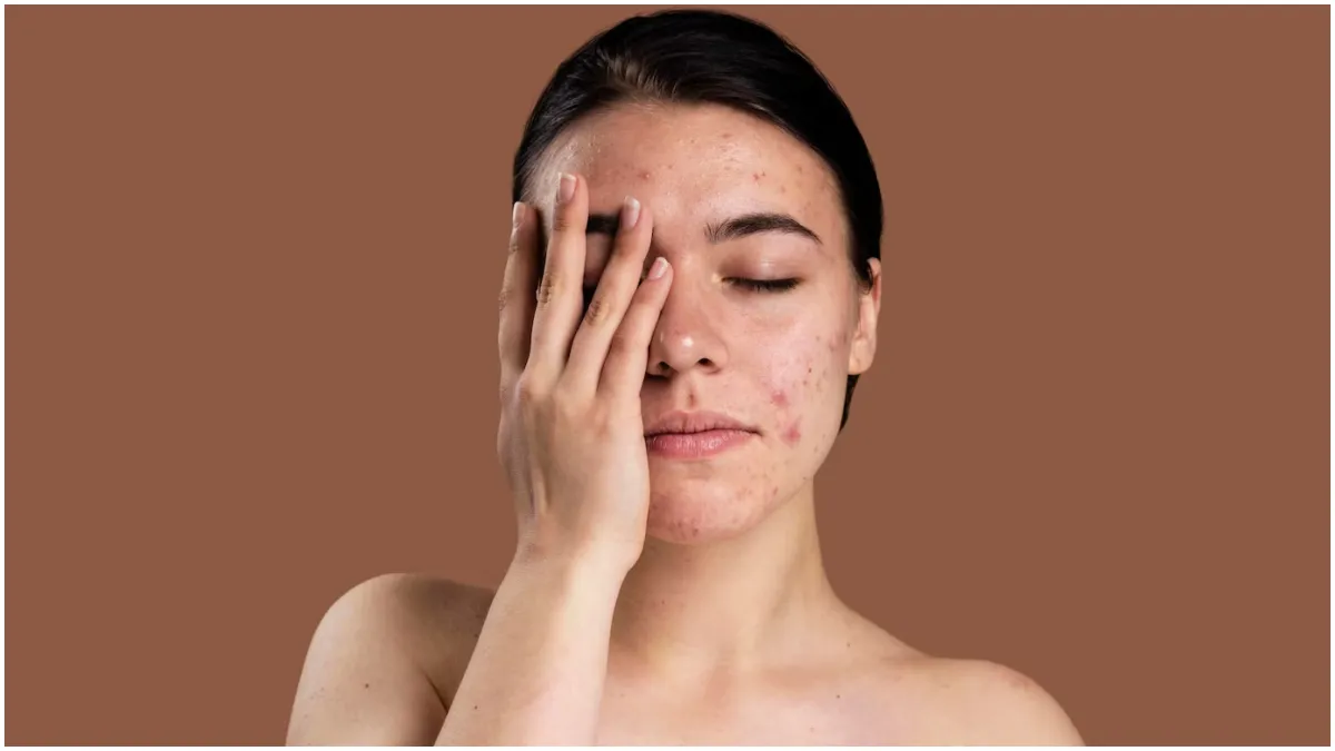 पिंपल्स के लिए घरेलू नुस्खा