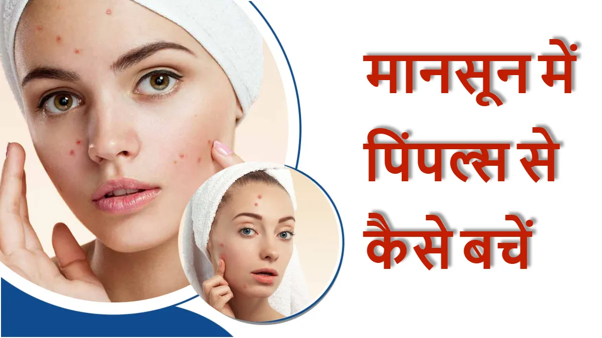 मानसून में पिंपल्स से कैसे बचें