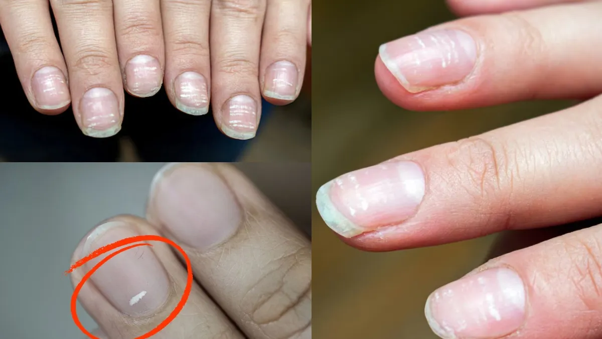 White Spots On Nails- India TV Hindi