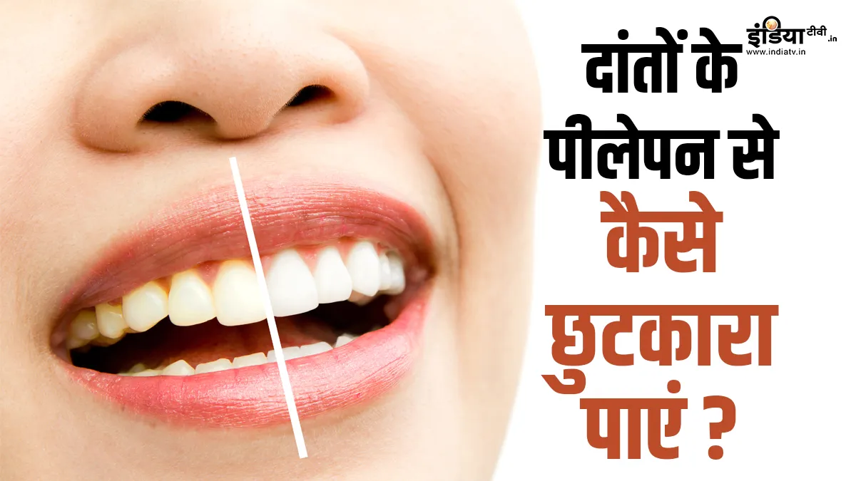 टीथ वाइटनिंग के लिए क्या करें?- India TV Hindi