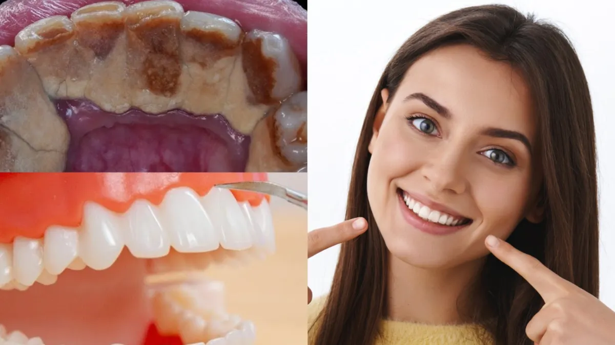 दांतों पर प्लाक कैसे कम करें- India TV Hindi
