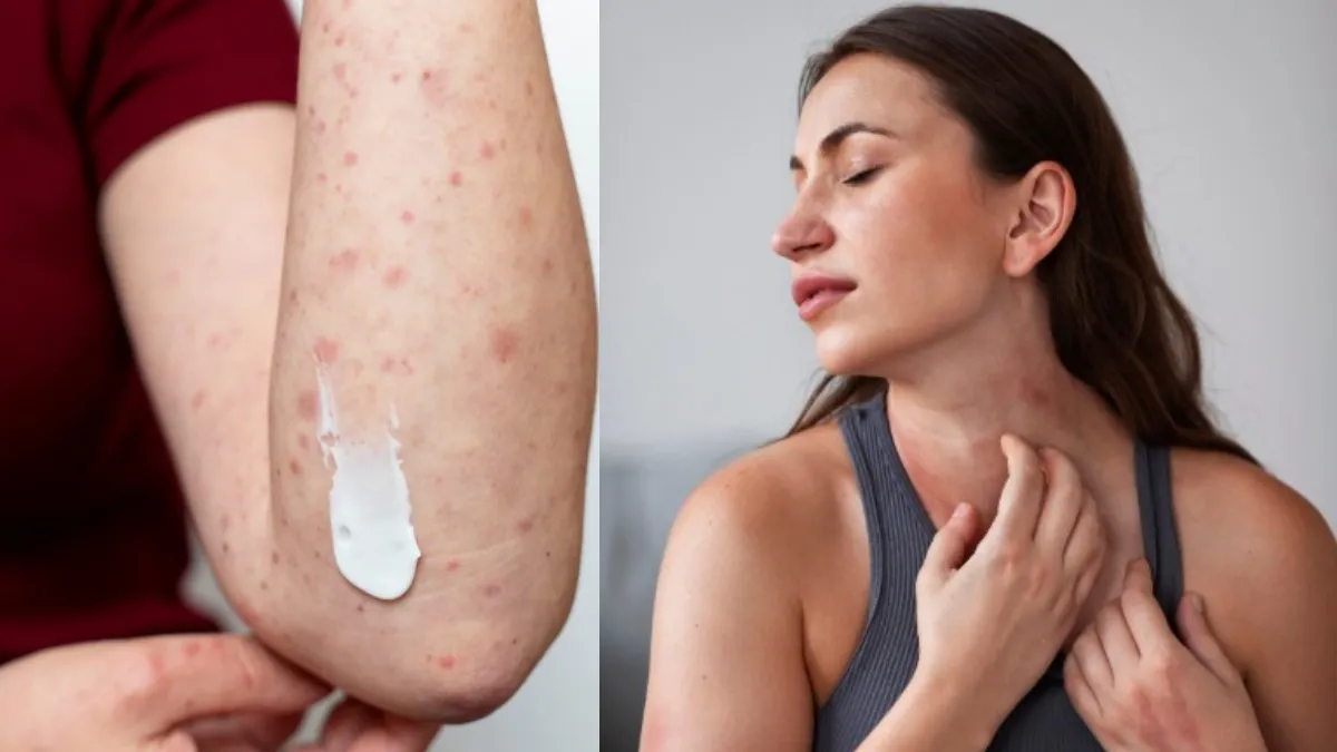 पित्ती उछलने पर क्या उपाय करें- India TV Hindi