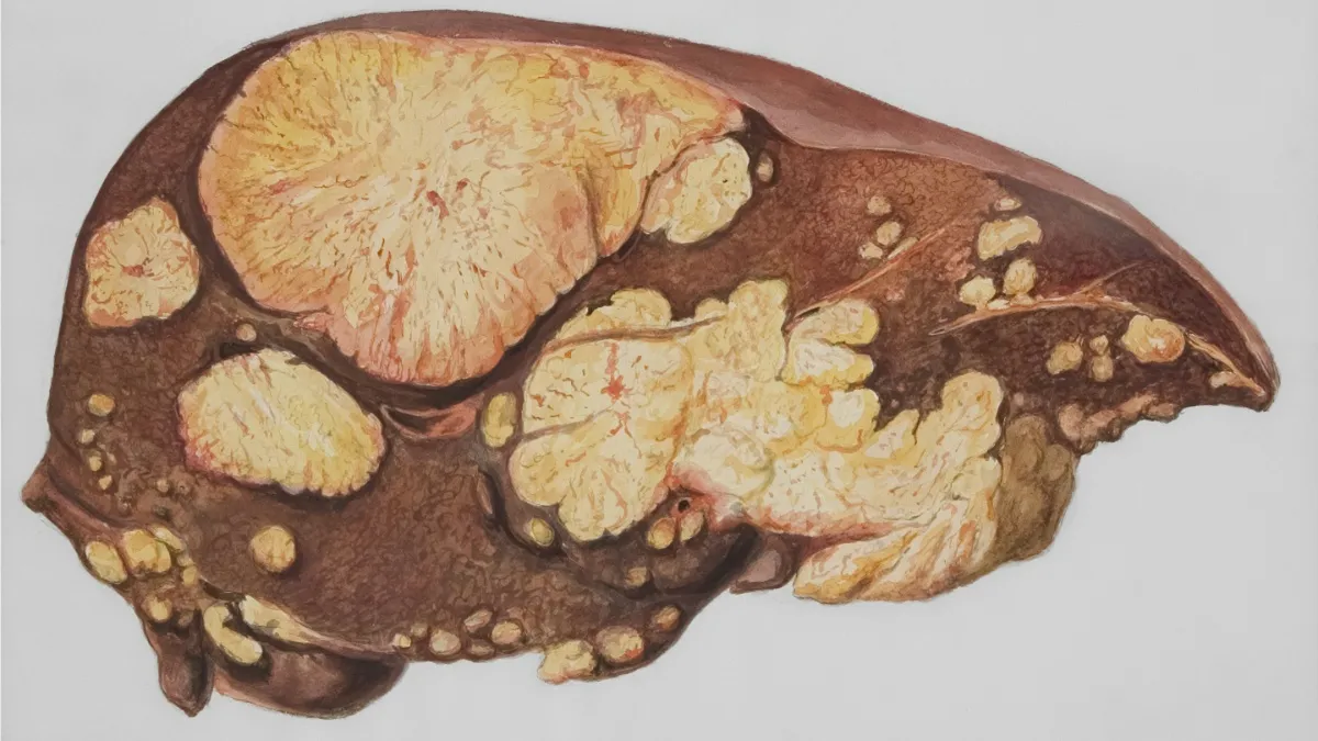 लिवर कैंसर - India TV Hindi