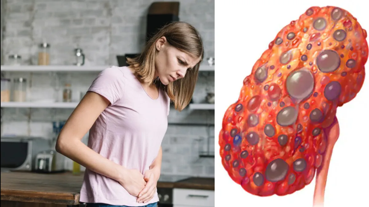 किडनी की बीमारी- पॉलीसिस्टिक किडनी डिजीज- India TV Hindi