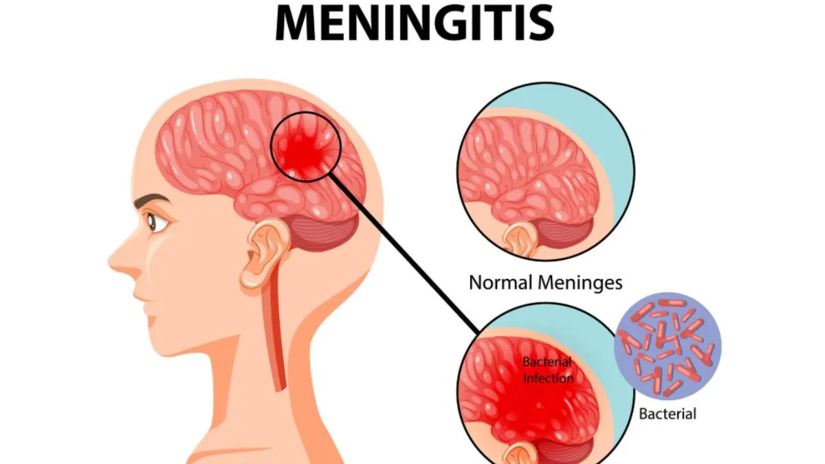 World Meningitis Day 2025- India TV Hindi