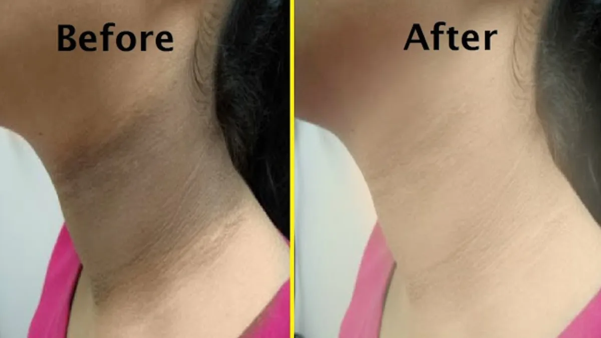 गर्दन से कालापन कैसे हटाएं- India TV Hindi