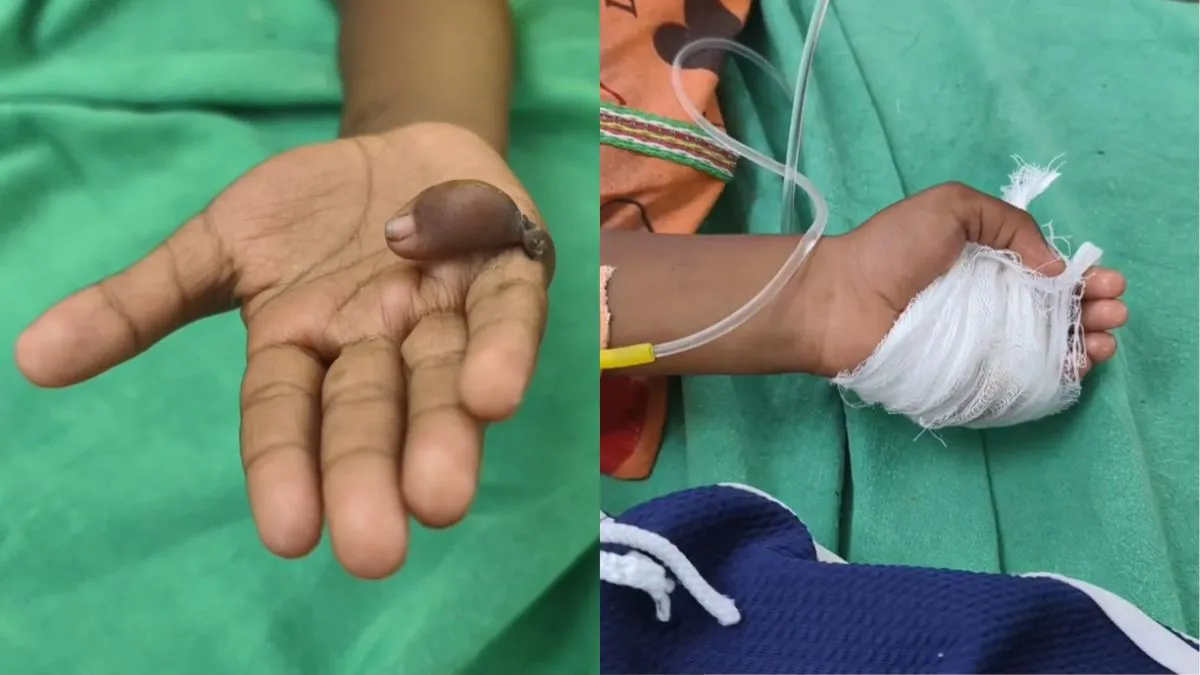 अस्पताल पर गलत हाथ का ऑपरेशन करने का आरोप।- India TV Hindi