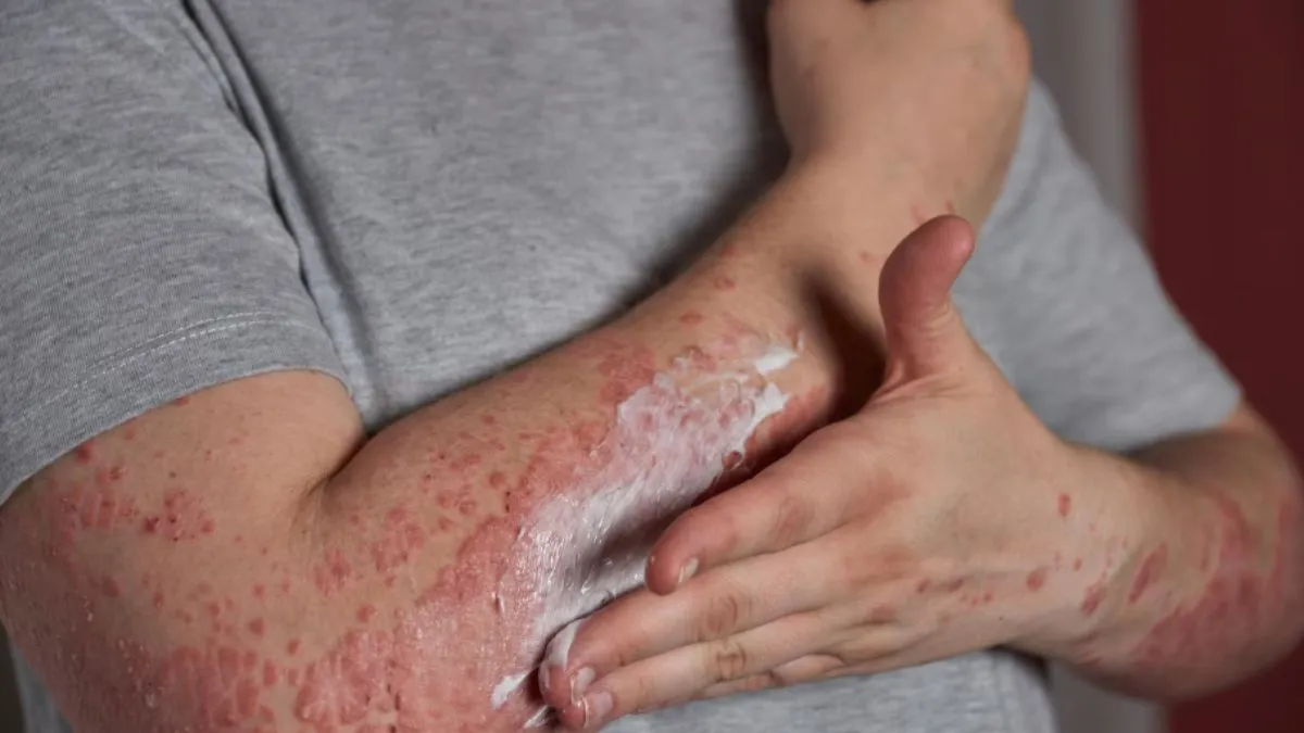 सोरायसिस क्या है? क्या हैं इसके लक्षण और असरदार इलाज- India TV Hindi