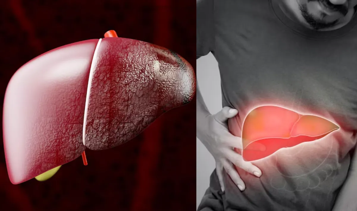 फैटी लिवर से लिवर सिरोसिस का खतरा- India TV Hindi