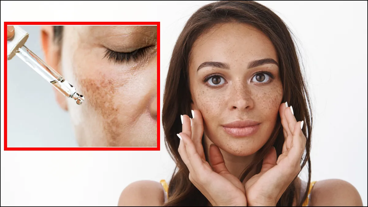 मेलाज्मा क्यों होता है?- India TV Hindi