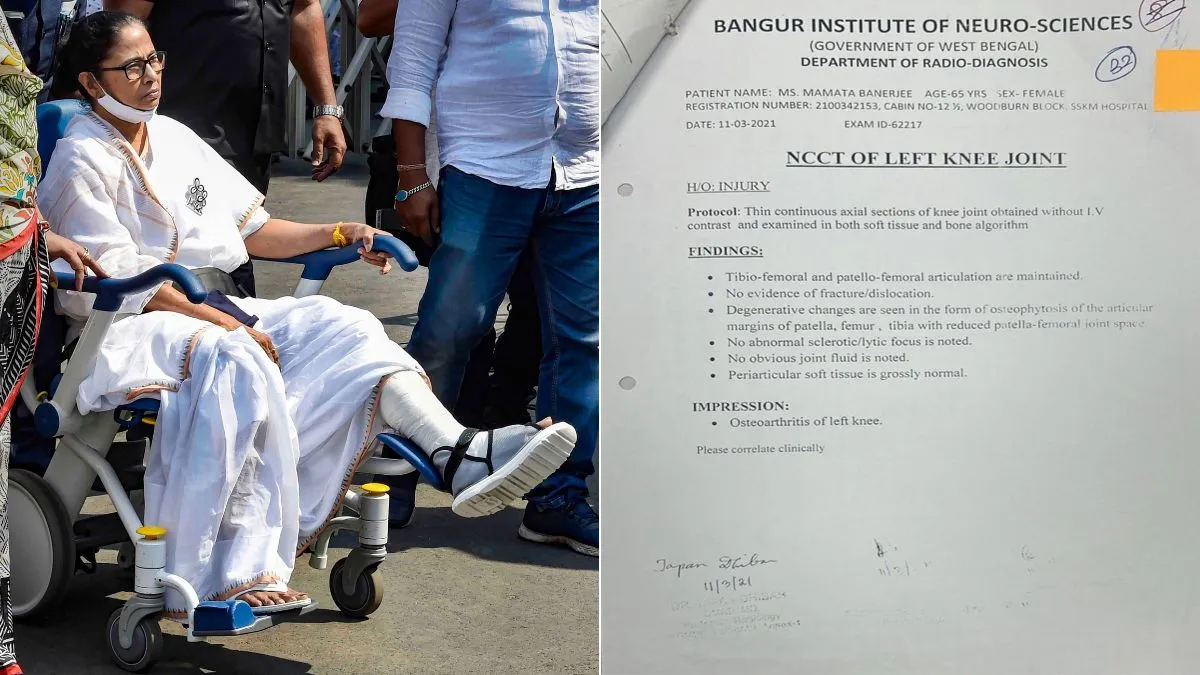 क्या ममता का पैर फ्रैक्चर था ही नहीं? मेडिकल रिकॉर्ड लीक होने से मचा बवाल, पूर्व CM ने अस्पताल को भेजा नोटिस