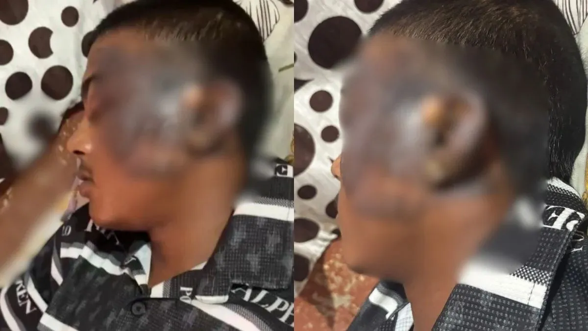 20 रुपये में 7 मोमोज देने पर छात्र ने पूछा सवाल, तो भड़का ठेले वाला; चेहरे पर फेंक दिया कढ़ाई का खौलता तेल