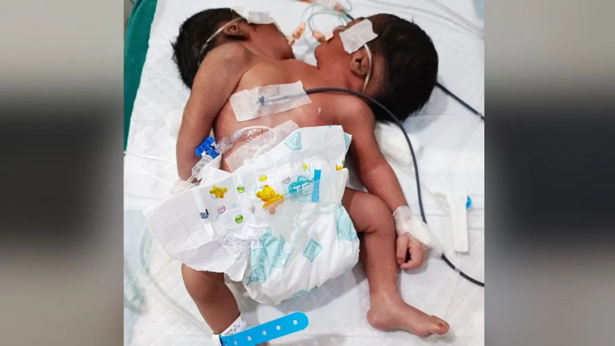 अस्पताल में हुआ दो सिर वाले बच्चे का जन्म, चमत्कार या मेडिकल डिसॉर्डर? डॉक्टरों की निगरानी में नवजात