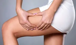 cellulite- India TV Hindi