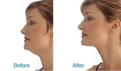 facial fat- India TV Hindi