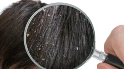 dandruff- India TV Hindi